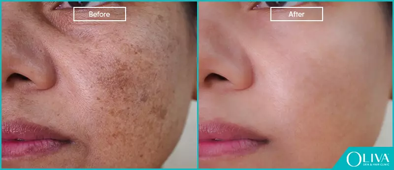 How to Overcome Dry Skin Naturally: