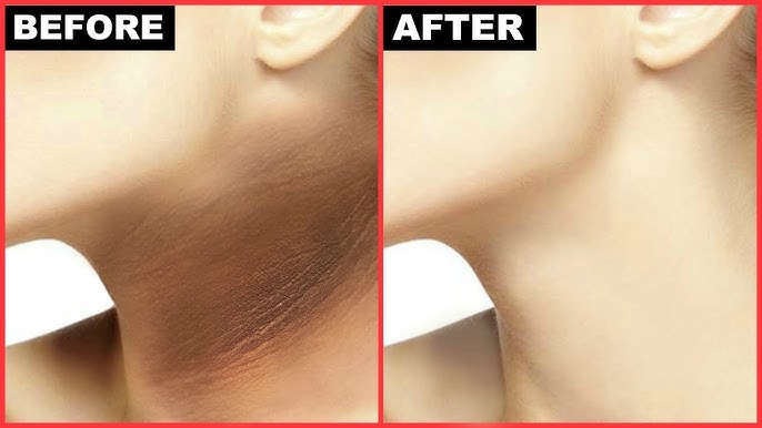 dark neck removal cream